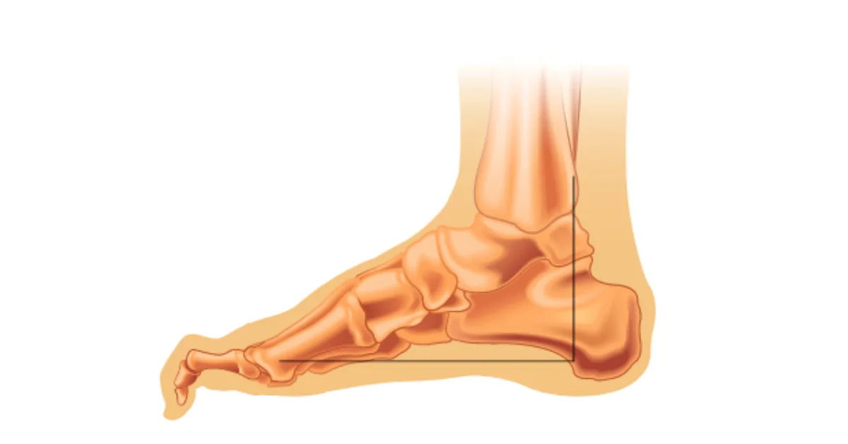 Dedos en martillo: Dolorosos pero tratables