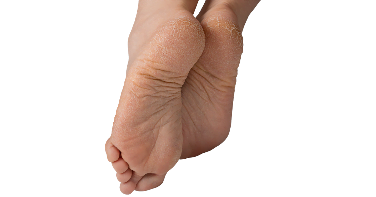 Hälsprickor torr hud